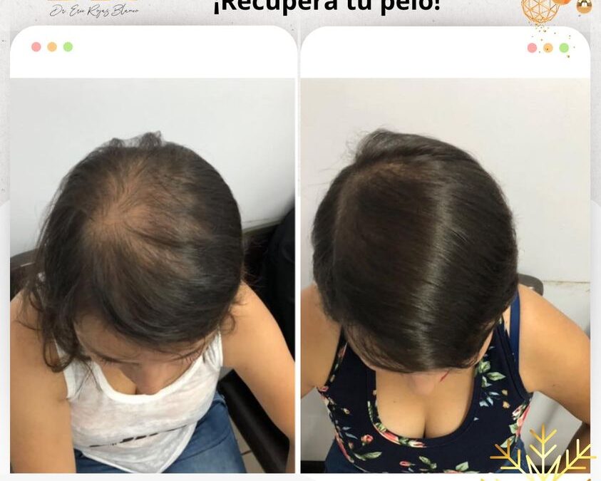 ¡Recupera tu cabello!👇😉