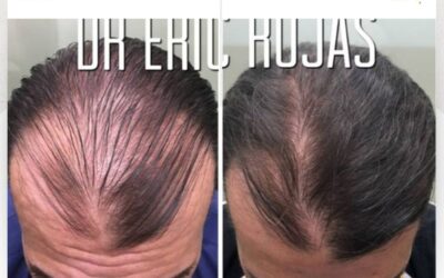 Recupera tu cabello con el mejor tratamiento.