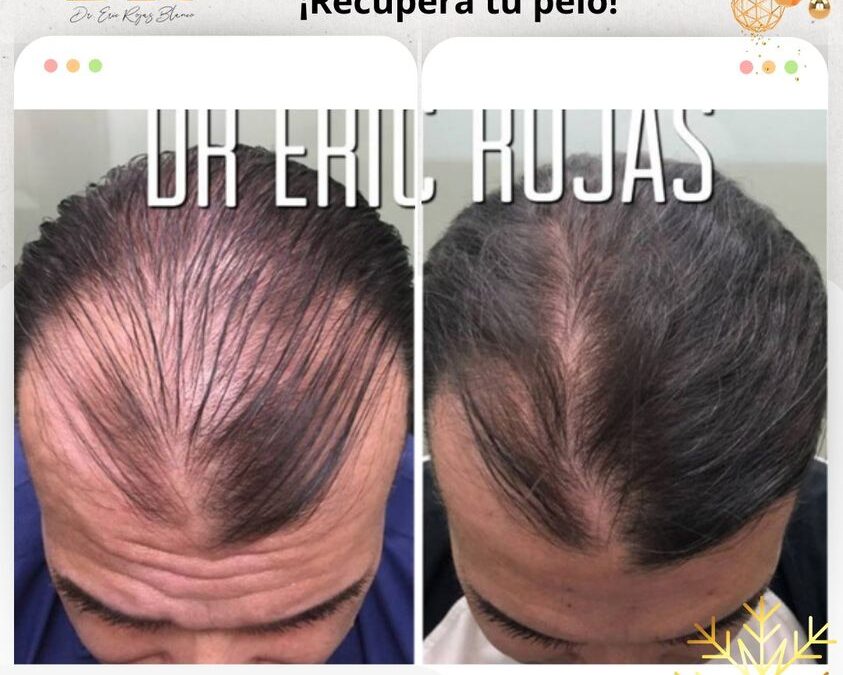 Recupera tu cabello con el mejor tratamiento.