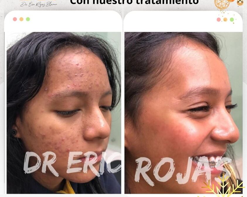 Rejuvenece tu rostro con la nueva técnica