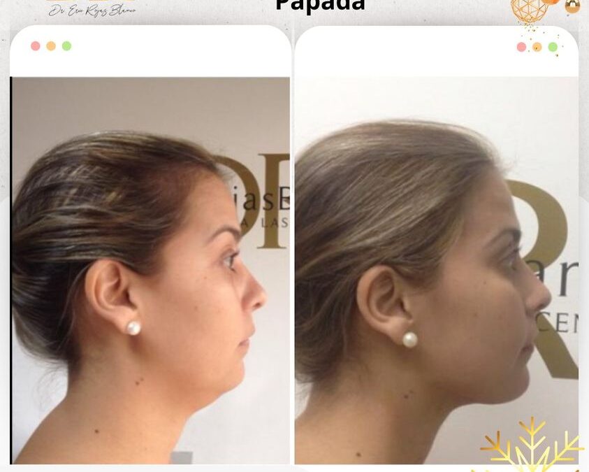 Slim Láser papada, realiza cambios increíbles