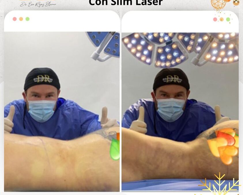 Slim láser
