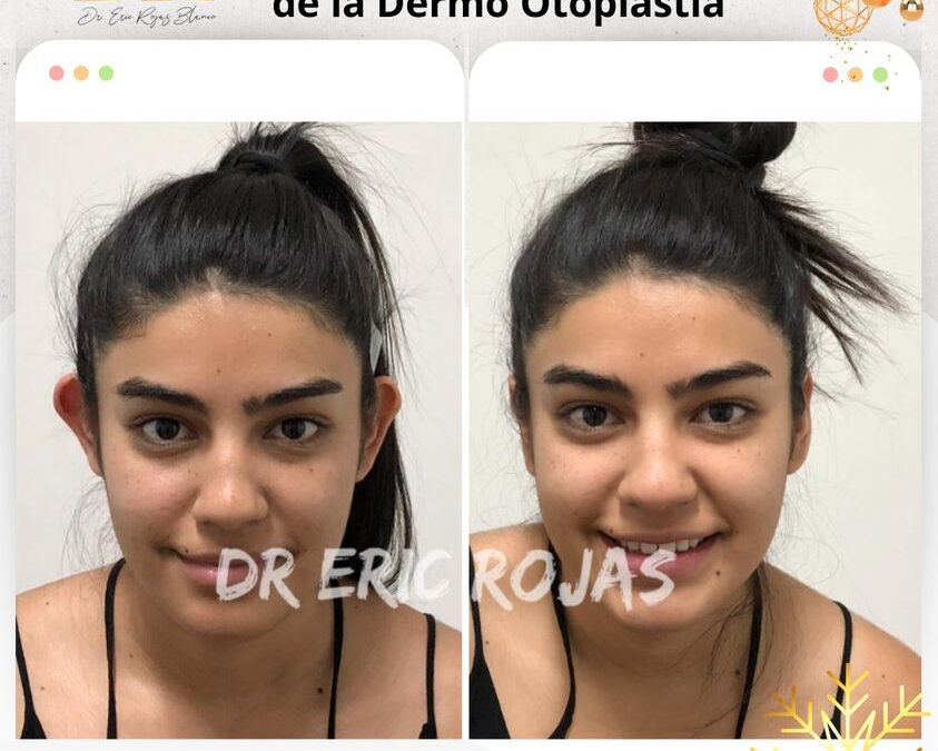 Dermo Otoplastía, corrige tus orejas, realiza cambios increíbles