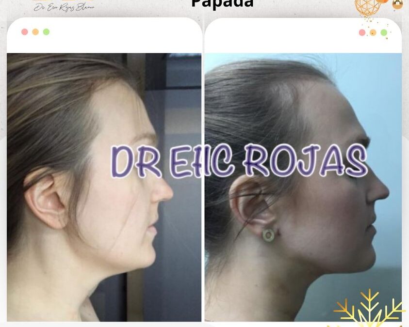Slim Láser papada, realiza cambios increíbles