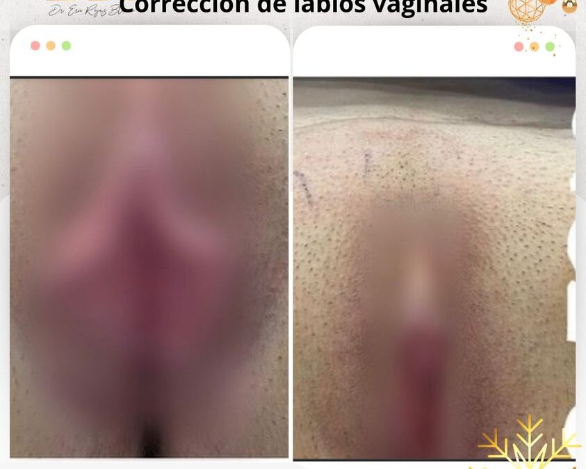Dermo Labioplastía, cambio increíble.👇😉