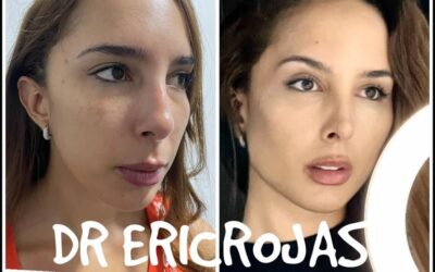Contorno mandíbular , formación de pómulos , levantamiento de cejas