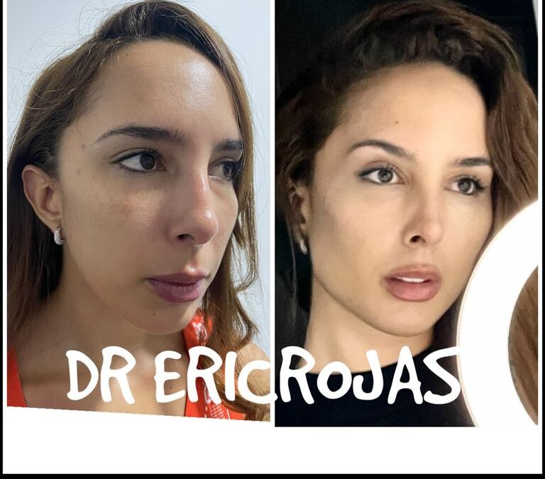 Contorno mandíbular , formación de pómulos , levantamiento de cejas