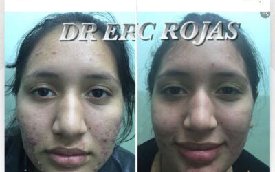 El mejor tratamiento de acné del país lo consigues en nuestra clínica.