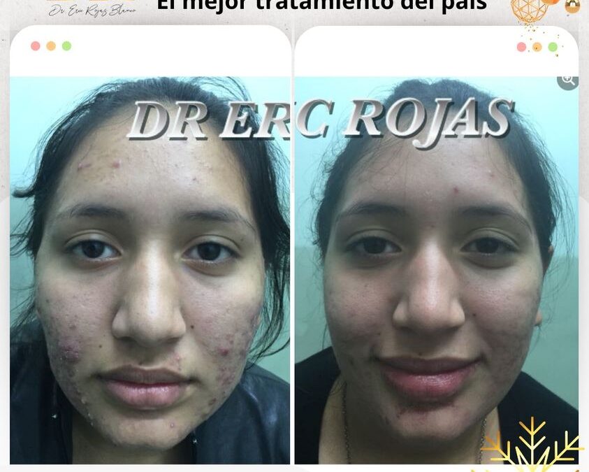 El mejor tratamiento de acné del país lo consigues en nuestra clínica.