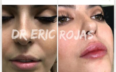 Relleno y moldeo de labios, increíble técnica