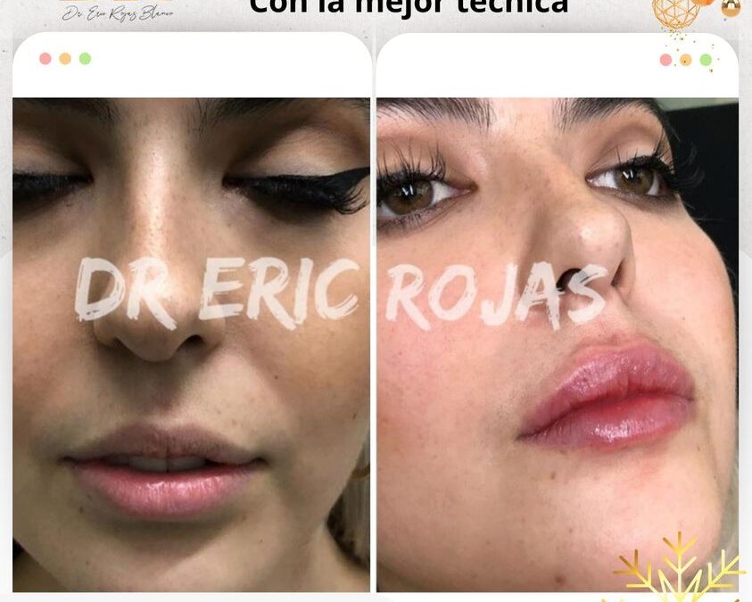 Relleno y moldeo de labios, increíble técnica