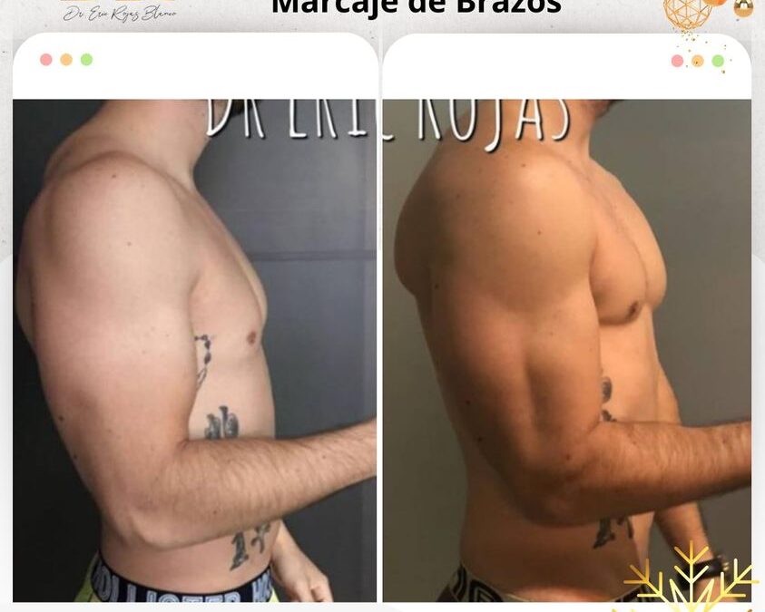 Slim láser en Brazos.👇😉