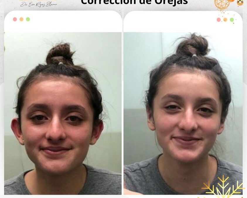 Dermo Otoplastía, corrige tus orejas, realiza cambios increíble
