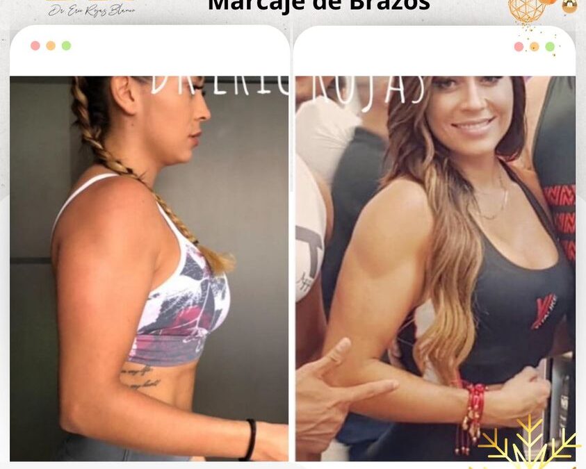 Marcaje de Brazos con Slim láser