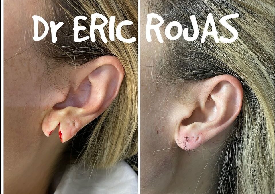Desgarro de oreja y reconstrucción de lóbulo DR ERIC ROJAS 22483535