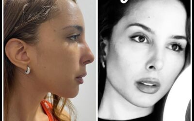 Perfilado facial , contorno de mandíbula , formación de pómulos y levantamiento de cejas