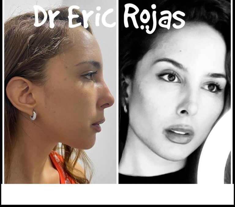 Perfilado facial , contorno de mandíbula , formación de pómulos y levantamiento de cejas