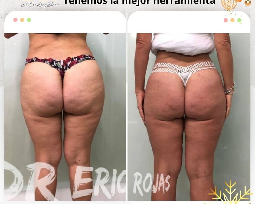 Elimina la celulitis de tu vida