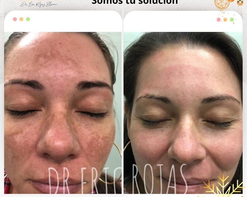 Dile adiós a las manchas con nuestro tratamiento.