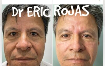 Rejuvenece tu rostro con la técnica única en el país