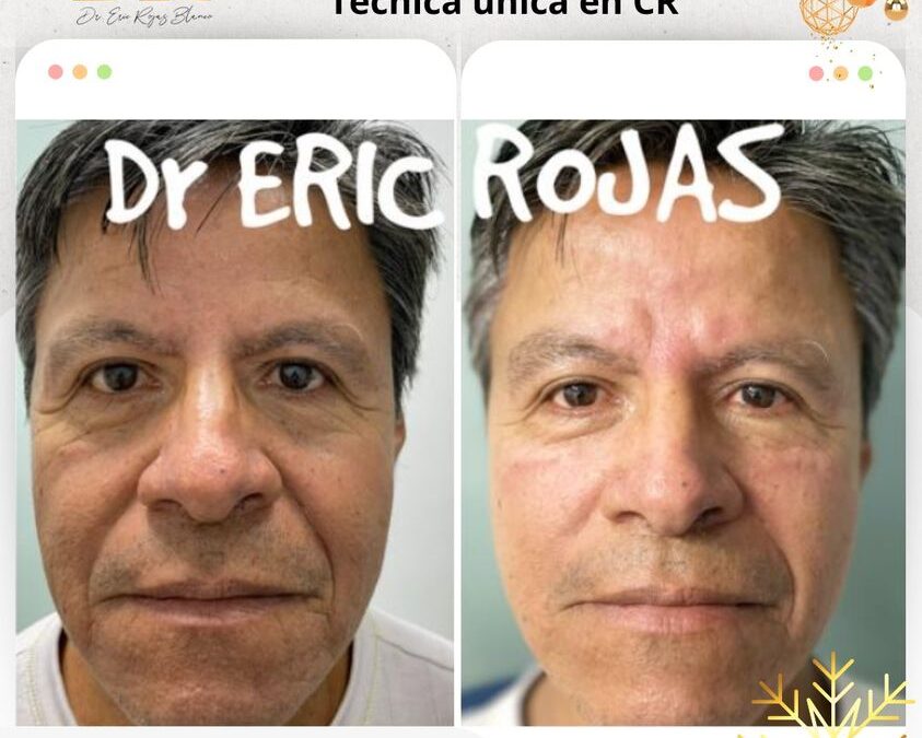 Rejuvenece tu rostro con la técnica única en el país