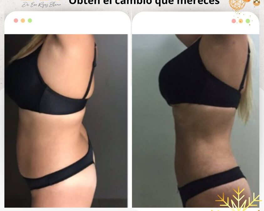 Slim Láser es lo que mereces