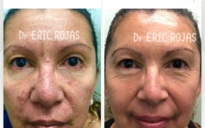 Limpia tu rostro con el mejor tratamientos del país
