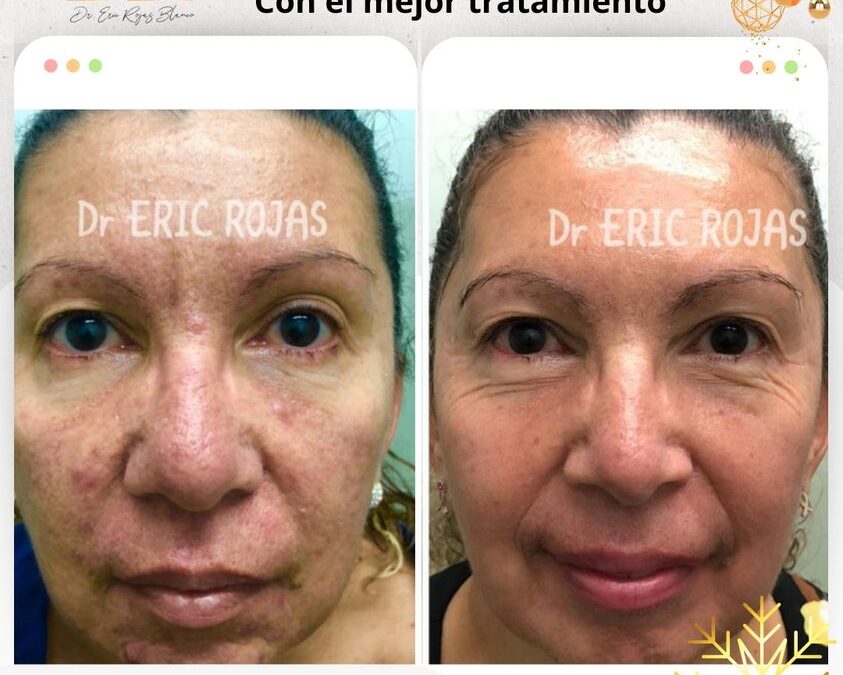 Limpia tu rostro con el mejor tratamientos del país