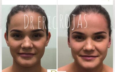Dermo otoplastía.