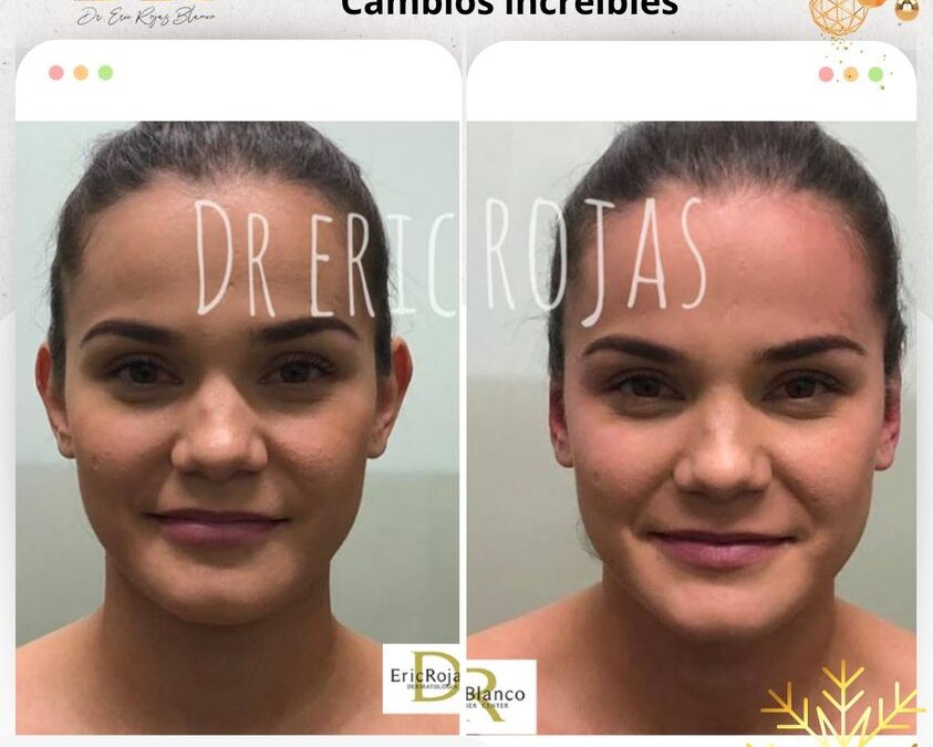 Dermo otoplastía.