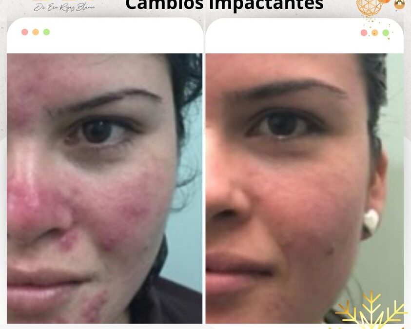 Cambios que mereces con el mejor tratamiento de acné.