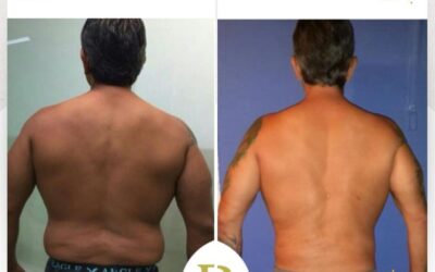 Slim Láser espalda, cambios increíbles.