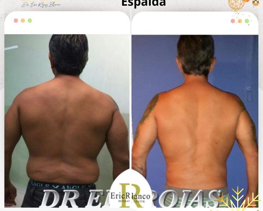 Slim Láser espalda, cambios increíbles.