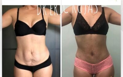 Puedes obtener estos cambios con Slim Láser