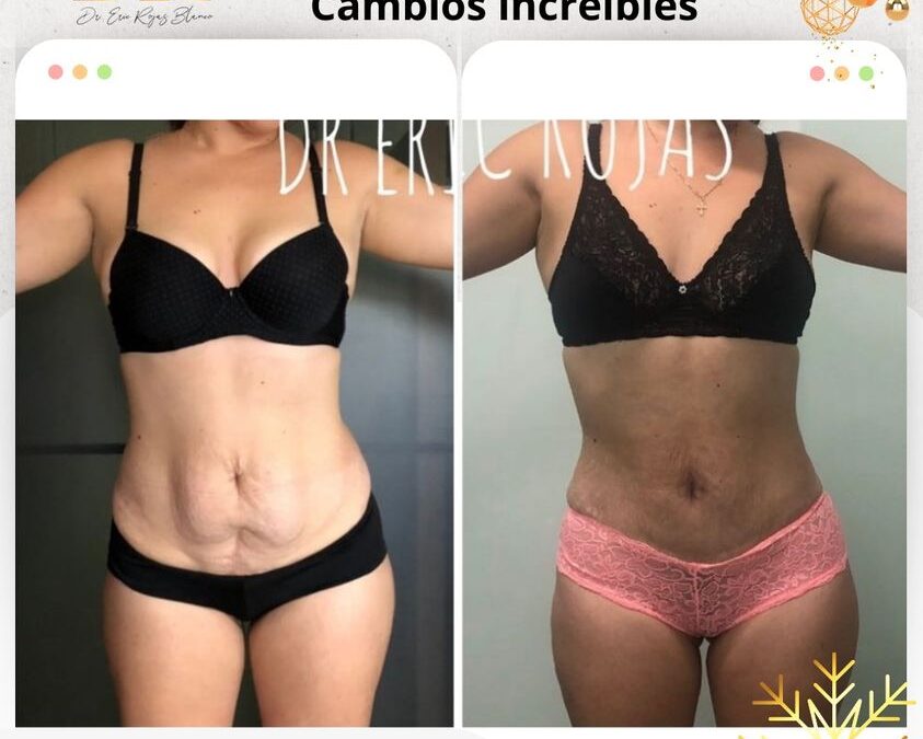 Puedes obtener estos cambios con Slim Láser