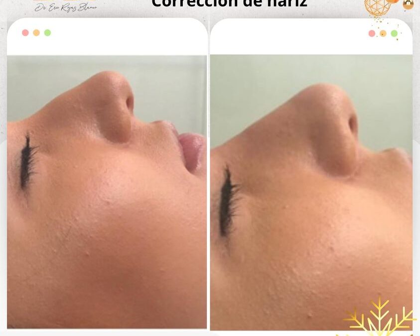Corrección de Nariz con Rinolift