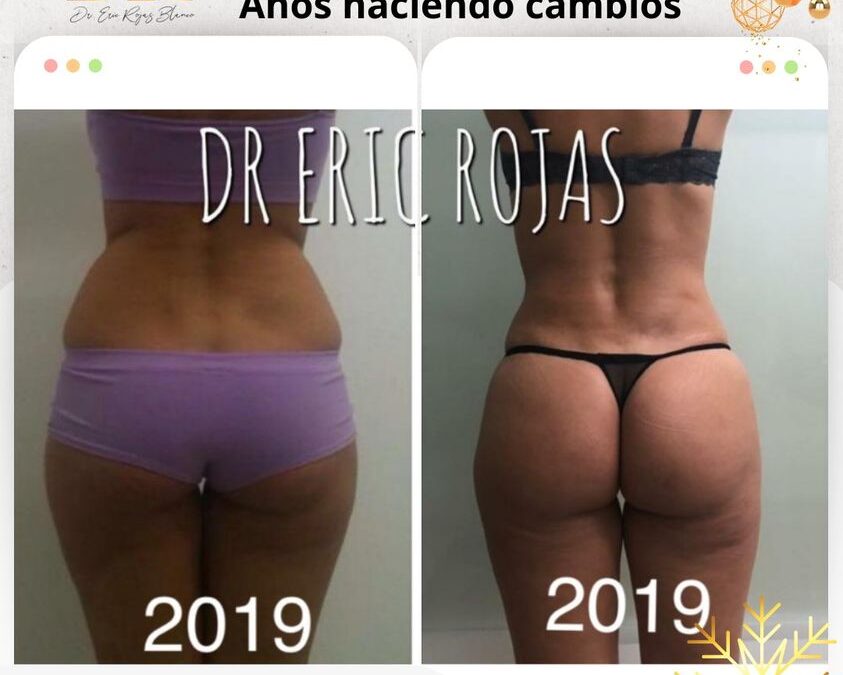 Slim Láser lleva años haciendo cambios impresionantes