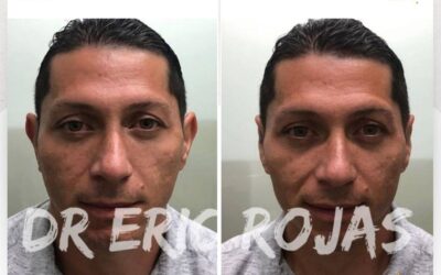 Corrección de orejas con la mejor técnica