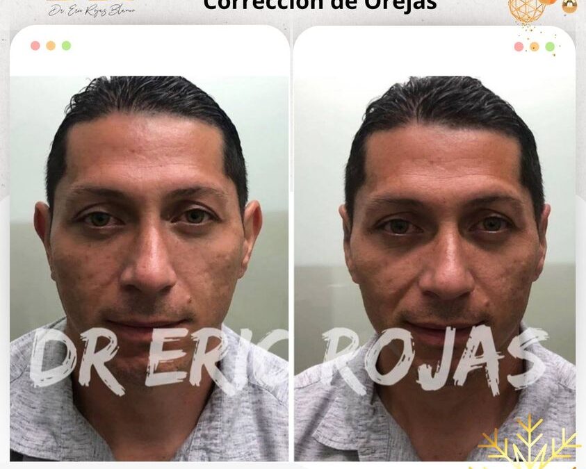 Corrección de orejas con la mejor técnica