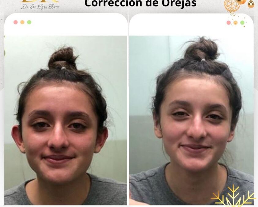 Dermo Otoplastía, corrige tus orejas, realiza cambios increíbles