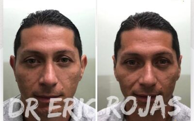 Corrige tus orejas con la mejor técnica