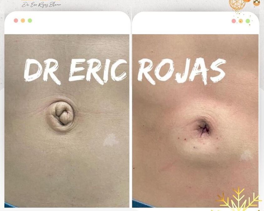 Corrección de ombligo.