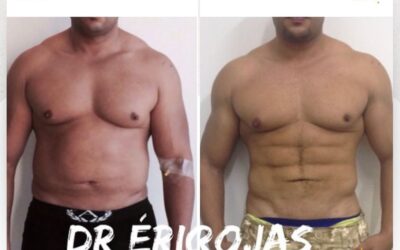 Marcaje de abdomen con Slim Láser