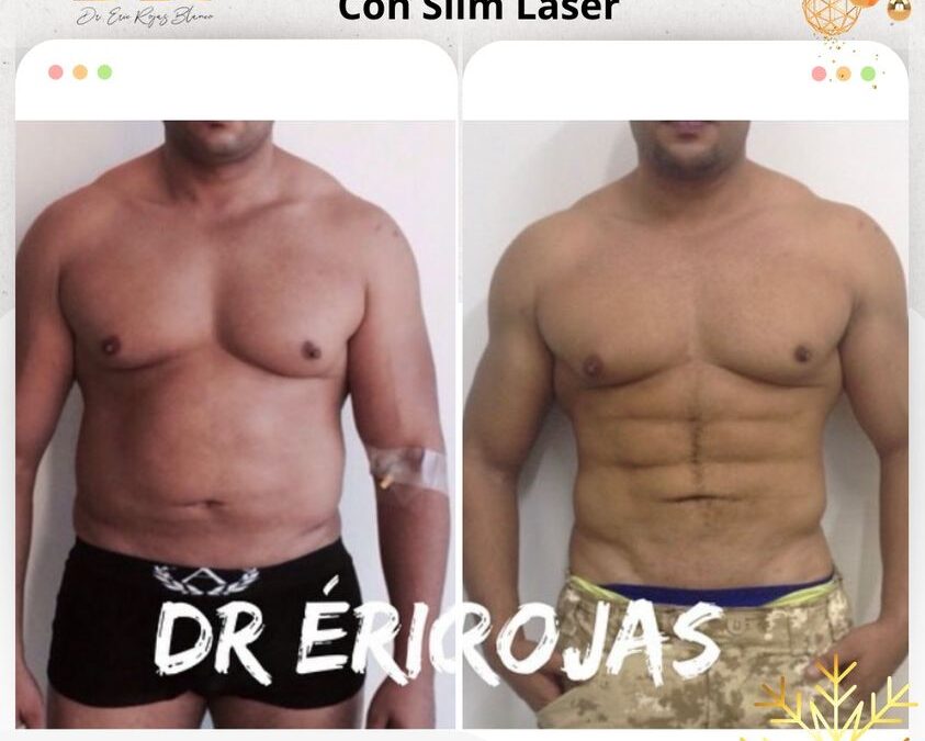 Marcaje de abdomen con Slim Láser