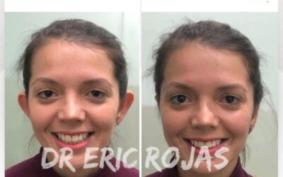 Dermo Otoplastía