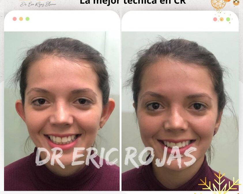 Dermo Otoplastía
