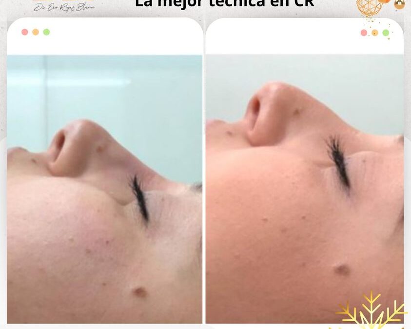 Corrección de Nariz