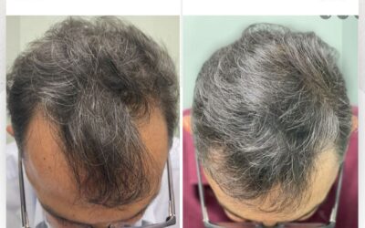 Trata tu alopecia, nosotros somos su solución.