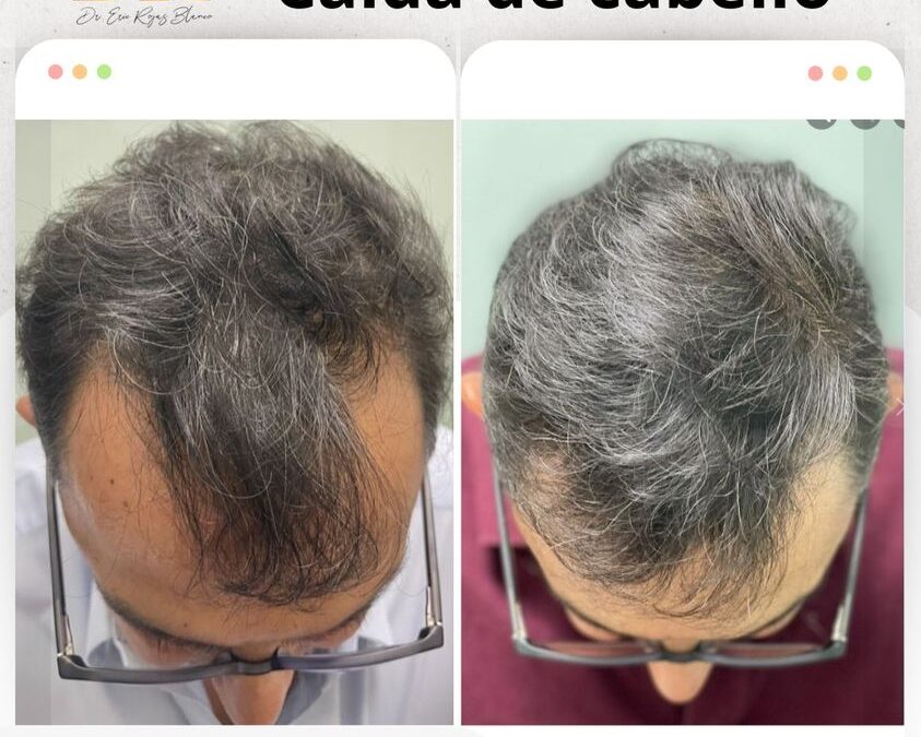 Trata tu alopecia, nosotros somos su solución.
