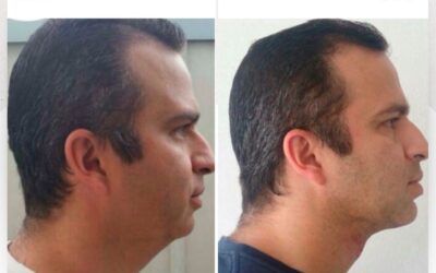 Mira los increíbles resultados del Slim Láser en papada ¿Qué te pareció el cambio?